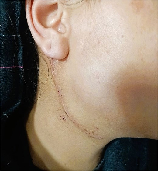 Picture taken of incision site on follow up at 7th postoperative day showing healthy wound and return of normal neck contour.