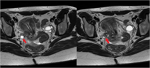 The left image illustrates a dilated right ureter (arrow) due to the presence of endometriosis in the right parametrium, as a T2-hypointense cordly-shaped zone in the parametrium. The right image shows endometriosis in the right antero-lateral parametrium encasing (arrow) the right distal ureter.