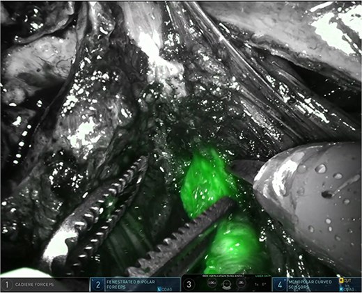 Easy identification of the surgical margins between the connective tissue in the parametrium and the distal ureter using ICG.