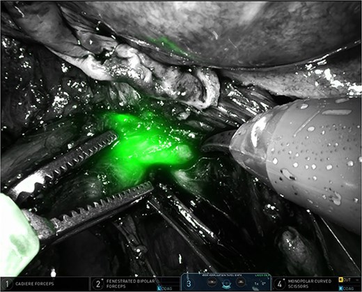 Partially stenosed and medially distorted ureter visualized by ICG and NIRF.