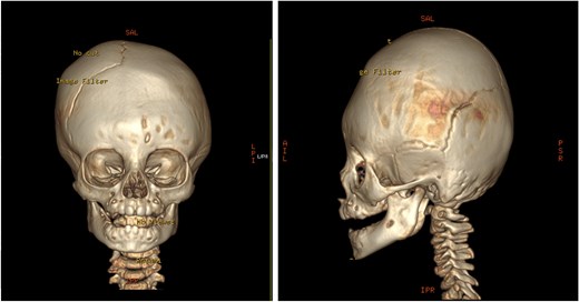 Pre-operative 3D reconstruction CT showing left plagiocephaly with towering, and a subtle harlequin sign.
