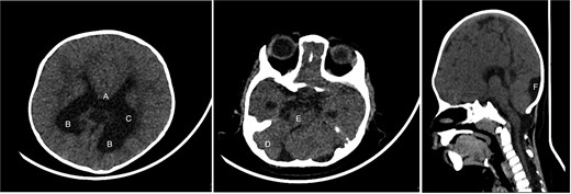 Brain CT showing: A-corpus callosum agenesis, B-colpocephaly, C-mild ventriculomegaly, D-right cerebellar and E-pontine hypoplasia, F-large cisterna magna.