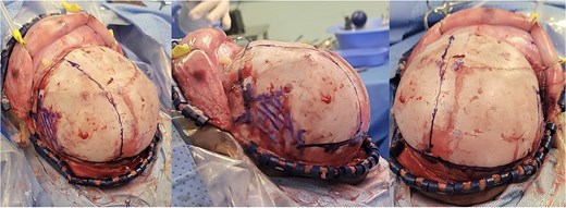 Intra-operative gross appearance of the left unilateral plagiocephaly with towering.