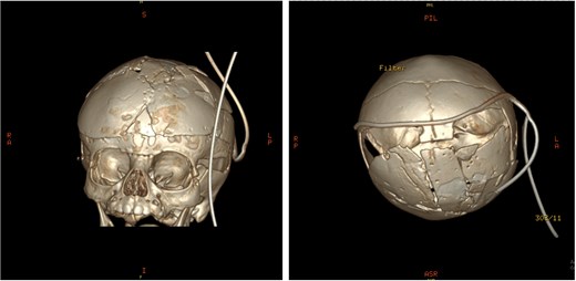 Post-operative 3D reconstruction CT showing skull shape correction and cosmetic results.