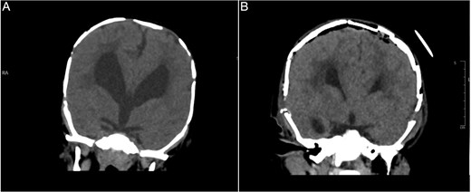 Brain CT bone window illustrating ventriculomegaly and bone resorption at six-month follow-up (A), compared to immediate post operative image (B).