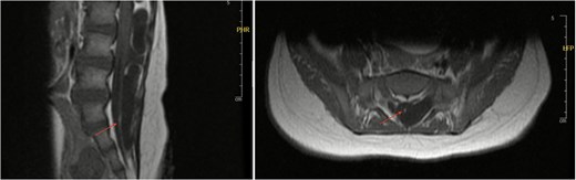 Axial and sagittal views of spinal MRI showing tethering of the cord at the level of S1 (arrows).
