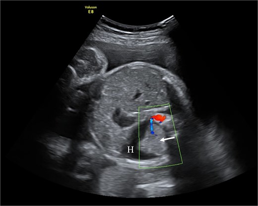 Fetal ultrasound with doppler. The arrow points to PS having a separate feeding branch from the aorta. Around sequestration the hydrothorax is present (H).