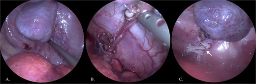 Thoracoscopic removal of PS. (A) Visualized PS in the thoracic cavity. (B) Displayed feeding artery (A) of lung sequestration. (C) Feeding artery is clamped with clips (arrow).