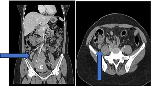 CT images with blue arrow pointing to inflamed appendix.
