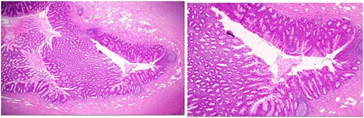 Low-power hematoxylin and eosin-stained sections of the appendix (4× and 10× magnification) demonstrating prominent crypt serration within the appendiceal mucosa with the characteristic saw-toothed crypt architecture and increased mucin production.