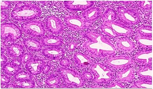 High-power view showing comparison of the adjacent normal appendiceal mucosa with unremarkable straight crypts lining the lumen and the serrated architecture of the polyp.