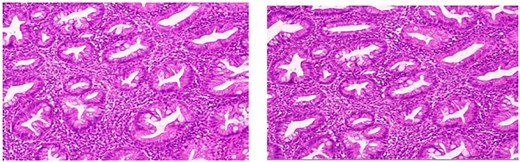 High-power magnification highlighting the serrated configuration of the crypt epithelium in detail, with luminal tufting and goblet cell-rich lining.