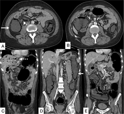 Contrast-enhanced CT of the abdomen and pelvis in axial (A, B) and coronal (C–E) planes showing a long segment of pneumatosis intestinalis involving the remaining descending colon, transverse colon, and proximal sigmoid colon, with suspicion of bowel perforation (bold arrow). Pneumobilia is present (dashed arrow). An eccentric intraluminal hypodensity within the IVC (arrowhead) is consistent with a non-occlusive thrombus, with a possible thrombus in the inferior mesenteric vein.