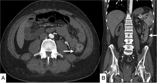 Selected CT angiogram of the abdomen and pelvis in axial (A) and coronal (B) planes showing mild diffuse thickening and mucosal hyper-enhancement of the descending colon, with prominent feeding mesenteric arteries and early draining vein dilation, consistent with angiodysplasia.