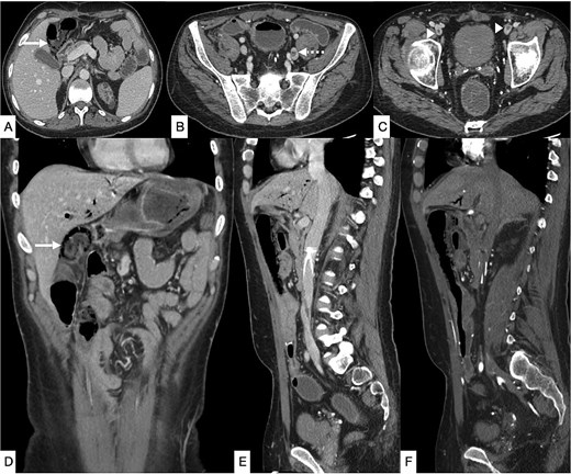 Contrast-enhanced CT of the abdomen and pelvis in axial (A–C), coronal (D), and sagittal (E, F) planes showing diffuse pneumatosis intestinalis just proximal to the previous anastomotic site (bold arrow), consistent with bowel ischemia. New thrombi are identified within the left common iliac vein (dashed arrow) and bilateral common femoral veins (arrowhead). Mild residual pneumobilia is present. An IVC filter is seen in situ.