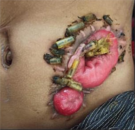 Status at one-month follow-up in a 3-year-old female with anorectal malformation after buttonpexy repair of a prolapsed divided descending colostomy. One-month follow-up after buttonpexy repair.