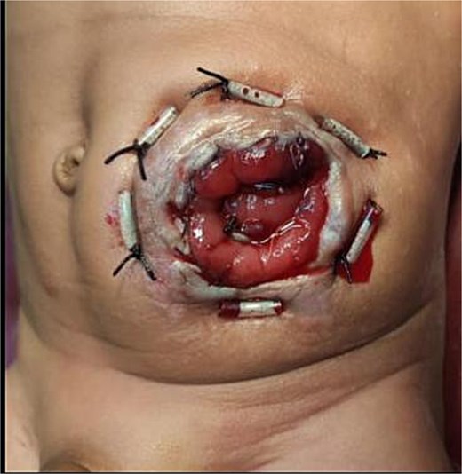 Postoperative appearance following buttonpexy repair in a 4.5-month-old child with Hirschsprung’s disease. Postoperative view showing buttonpexy fixation.