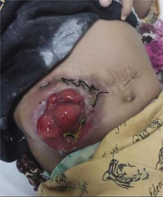 Follow-up at one month after buttonpexy repair in an 8-month-old child with Hirschsprung’s disease. The stoma remains stable with no recurrence of prolapse. One-month follow-up showing well-healed stoma.