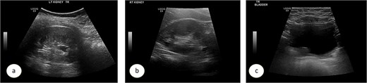 Ultrasound images showing the left (a), and right (b) kidneys and the urinary bladder (c). VCUG is showed bilateral grade 3 VUR (d). DMSA images are shown in (e).