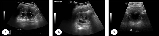 Post Deflux injection ultrasound images showing the left (a), and right (b) kidneys and the urinary bladder (c).