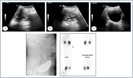Ultrasound images taken 1 month after the removal of both double J stents, showing no hydronephrosis in either kidney—the left (a) and right (b)—and urinary bladder with Deflux in place (c).