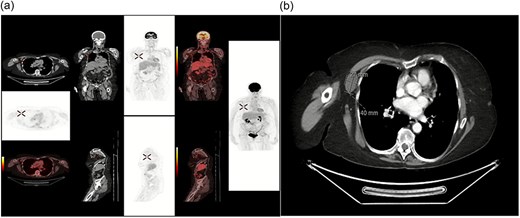 (a) FDG PET/CT showing hypermetabolic focus in the right axilla, consistent with metastatic disease from a colorectal primary tumour (confirmed with biopsy) (b) CTAP showing incidental right axilla mass.