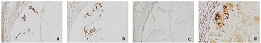 Immunohistochemistry (IHC) for mismatch repair proteins in right hemicolectomy sample at 20× magnification. (a) MLH1 retention in tissue (b) MSH2 retention in tissue. (c) MSH6 loss observed in tissue (d) PMS2 retention in tissue.