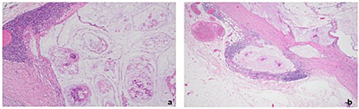Histopathology of excised right axillary lymph nodes. (a) Malignant acinar architecture with high levels of extracellular mucin indicative of mucinous adenocarcinoma (Haematoxylin & eosin stain at 10× magnification) (b) Extranodal expansion of mucin into capsule (Haematoxylin & eosin stain at 4× magnification).