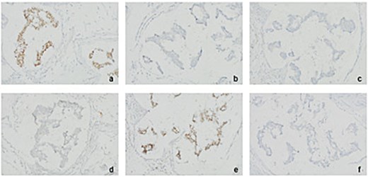 Immunohistochemistry (IHC) for various tumour markers in excised right axillary lymph nodes points towards colorectal origin of tumour (at 20× magnification). (a) CDX2 positive (b) CK20 negative (c) ER negative (d) Napsin-a negative (e) SATB2 positive (f) TTF1 negative.