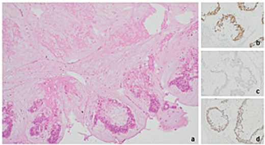 Histopathology of level 1 lymph node from right axillary clearance pointing towards metastatic mucinous adenocarcinoma of colorectal origin (a) tumour present with necrosis (Haematoxylin & eosin stain at 10× magnification) (b) CDX2 positive (20× mag.) (c) CK20 negative (20× mag.) (d) SATB2 positive (20× mag.).