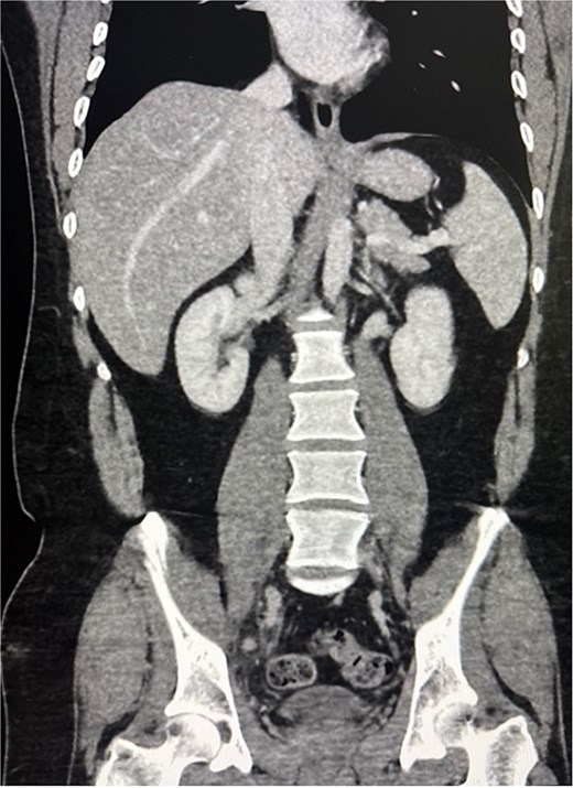 CT scan of the abdomen and pelvis showing acute appendicitis with the appendix extending toward the right femoral canal.
