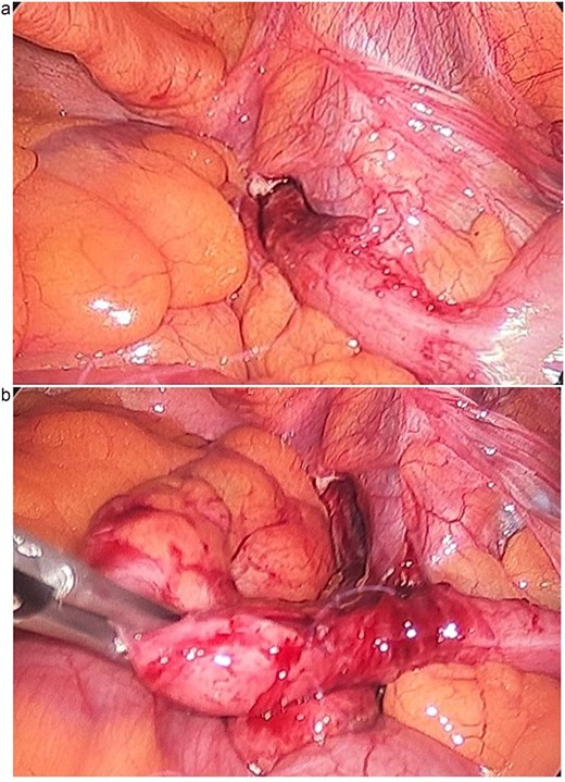 Intraoperative laparoscopic views. (a) Inflamed appendix herniated within the femoral canal, consistent with a De Garengeot hernia. (b) The appendix following reduction from the femoral canal prior to appendectomy.
