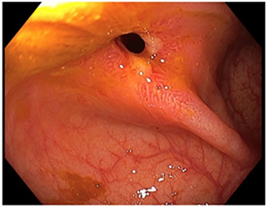 Colonoscopic picture of the diaphragm-like stricture in the ascending colon, 60 cm from the anal verge.