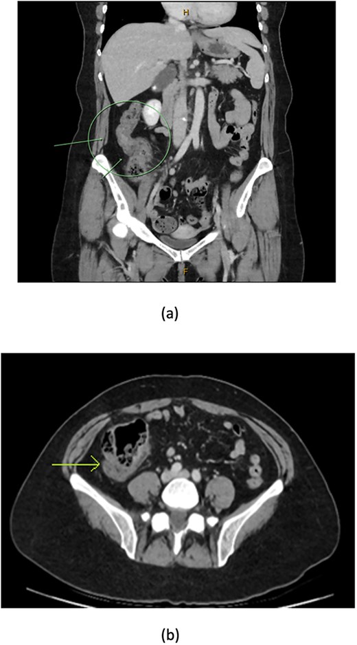 CT coronal (a) and axial (b) views showing thickening of the ascending colon (arrows) with faecalised and distended distal ileum.