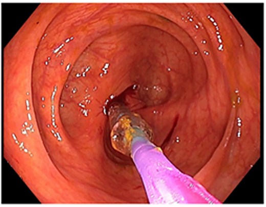 Attempted dilatation with a 6 mm balloon. The procedure was aborted after bleeding commenced.