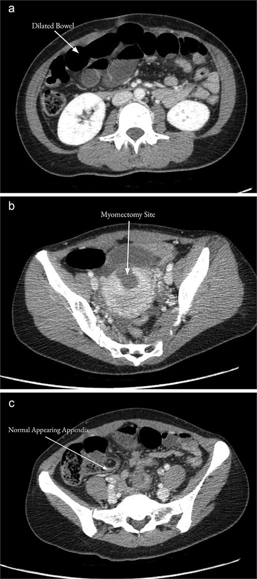 CT of the abdomen and pelvis with contrast on the day of admission showed multiple distended mid-distal small bowel loops indicating a possible small bowel obstruction (a). There was focal low density along the uterine myometrium consistent with the history of recent myomectomy (b). The appendix appeared normal (c).