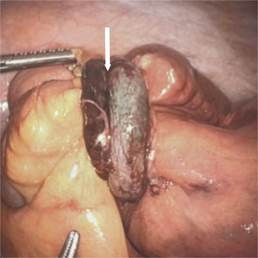 Intraoperative photograph of the necrotic-appearing appendix (arrow) encircling the small bowel 10 cm proximal to the terminal ileum causing a mechanical small bowel obstruction with a clear transition point.