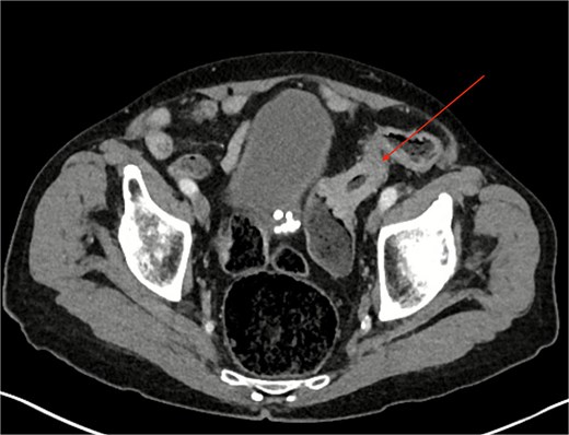 CT demonstrating sigmoid colon lesion.