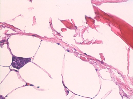 Small groups of acini, randomly distributed in lipomatous tumor.