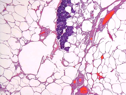Groups of acini and occasional ducts present within the lipomatous tumor.