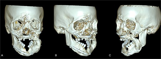Maxillofacial CT with 3-D volume after fibula free flap. The reconstructed left midface/mandible with fibula free-flap hardware is shown with resection margins and the osseous bridge. (A) Frontal view. (B) Right anterior view. (C) Left anterior view.