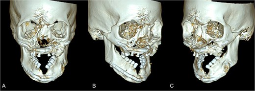 Postoperative maxillofacial CT with 3-D volume following revision surgery. The reconstructed left midface/mandible with is shown after removal of the osseous bridge. (A) Frontal view. (B) Right anterior view. (C) Left anterior view.