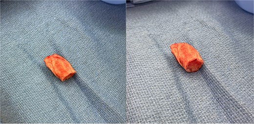 Intraoperative specimen of the osseous bridge excised en bloc from along the fibula free-flap pedicle. Photographs show the same specimen in two orientations with with heterotopic ossification.