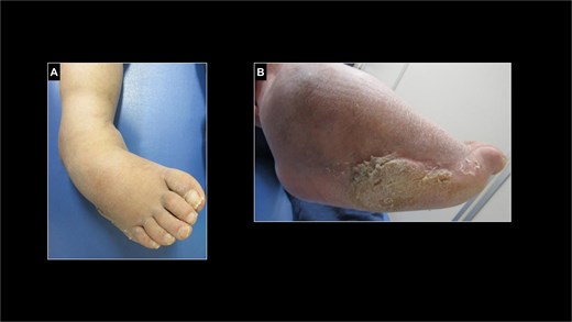 Preoperative photographs of the right foot. (A) The ankle joint showed varus and equinus deformity. (B) Painful callosities on the lateral aspect of the foot.