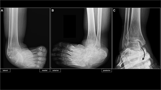 Preoperative radiographs of the right ankle. (A) Radiograph of right ankle in the antero-posterior weight-bearing view. (B) Radiograph of right ankle in the latero-medial weight-bearing view. (C) Preoperative ankle stressed imaging showed correctability of ankle and subtalar joint deformities, but non-correctable subluxation of the talonavicular joint.