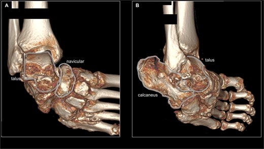 Preoperative CT imaging of the right foot. (A) 3D reconstructed image of preoperative CT scan from ankle joint frontal view. The talus and navicular bones are surrounded by black lines, showing subluxation of the talonavicular joint. (B) 3D reconstructed image of preoperative CT scan from ankle joint anterolateral view. The talus and calcaneus are surrounded by a black line, showing marked varus deformity of the subtalar joint.