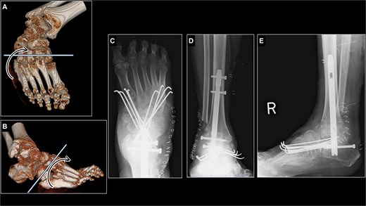Surgical planning and postoperative radiographs of the right foot just after surgery. (A, B) an osteotomy line was established from the first cuneiform to the cuboid. (C) Midfoot derotational osteotomy site was fixed with eight K-wires. (D, E) Hindfoot was fixed with retrograde intramedullary nail while varus and equinus deformity was corrected.