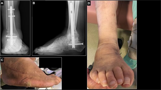 Postoperative radiographs and photographs of the right foot 1 year after surgery. (A, B) radiograph of right ankle in a weight-bearing position showed the fusion of osteotomy site and sustained plantigrade alignment. (C, D) The callosities of lateral aspect of foot had almost come off.