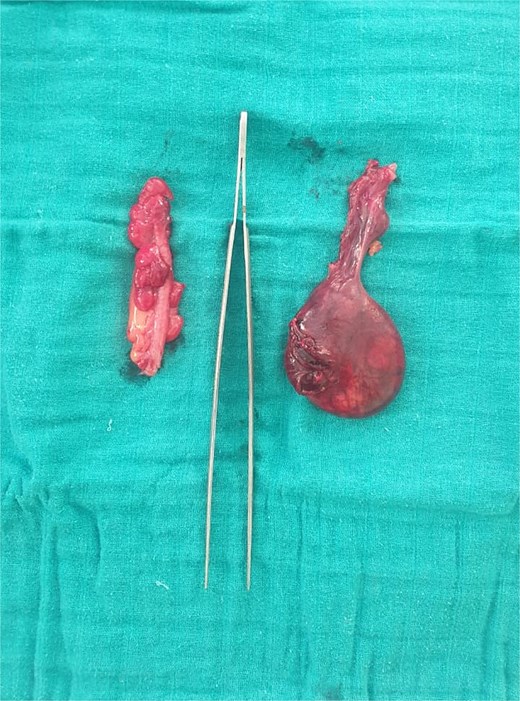 Image showing the two surgical specimens: the appendix on the left and the adnexa on the right.