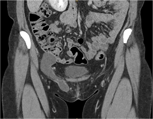 Coronal slice of CT demonstrating the bilobar right sided hydrocele of the canal of Nuck.